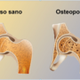 Osteoporosi, prevenirla si può