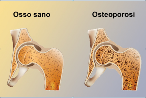 Osteoporosi, prevenirla si può