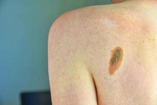 L'oncologo Ascierto: &quot;Aumentano casi melanoma, lampade abbronzanti come fumo&quot;