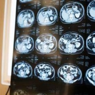 Neurologi: &quot;Noi fondamentali in gestione neoplasie cerebrali&quot;